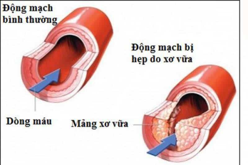 Những lợi ích tuyệt vời của rượu vang đỏ Chống xơ vữa động mạch cảnh